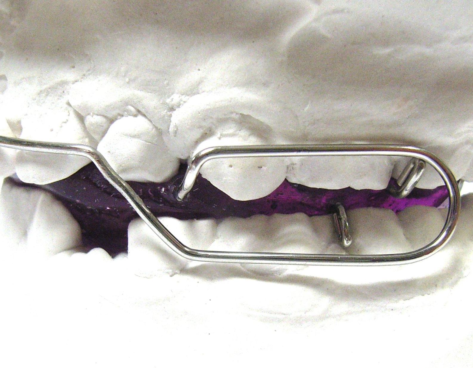 Bionator nach Ascher