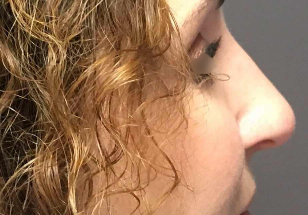 rhinoplastie techniqueSculptR