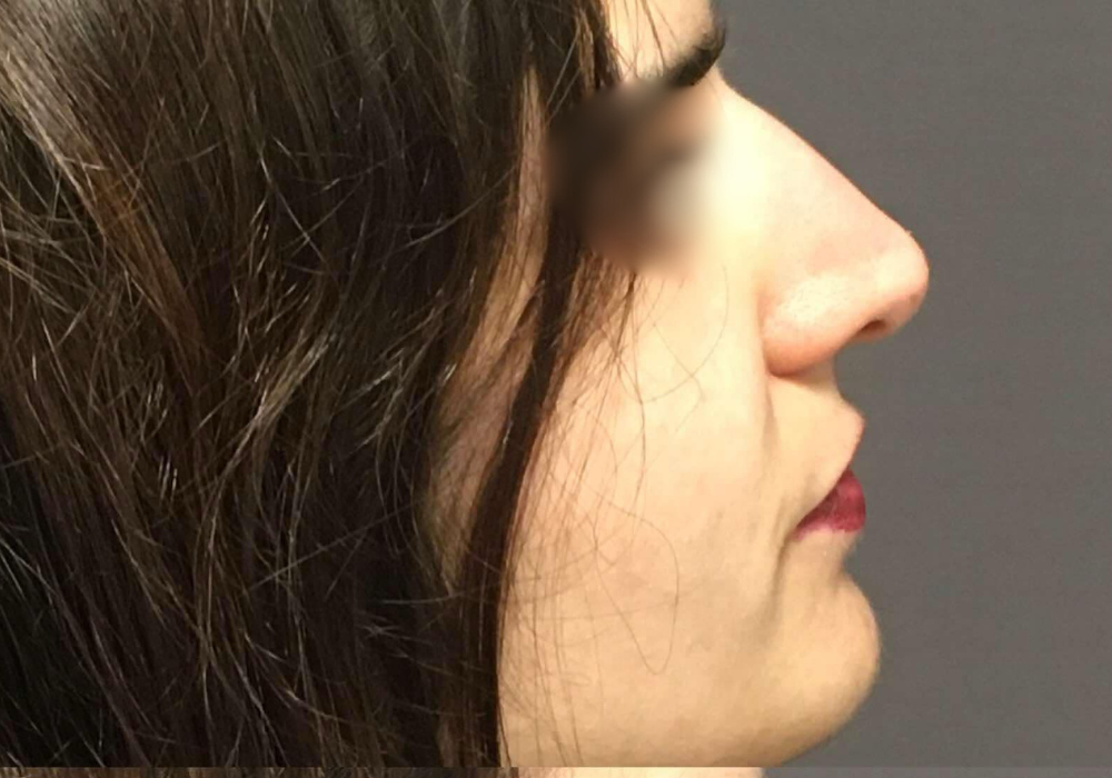 rhinoplastie techniqueSculptR