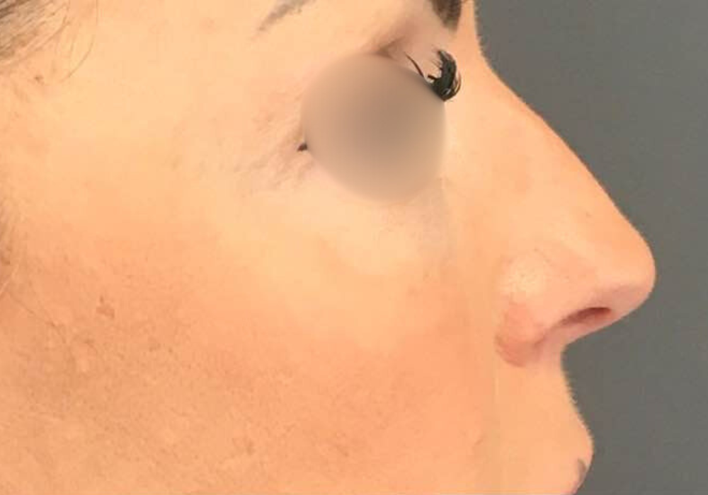 rhinoplastie techniqueSculptR