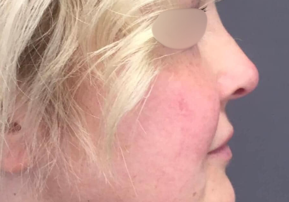 rhinoplastie techniqueSculptR