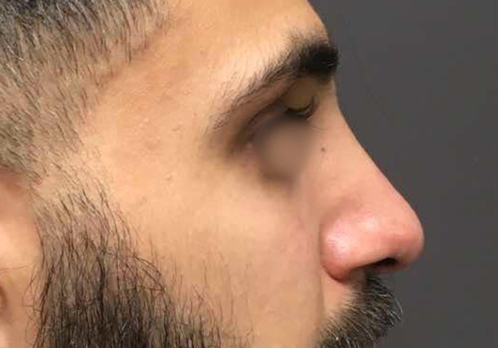 rhinoplastie techniqueSculptR