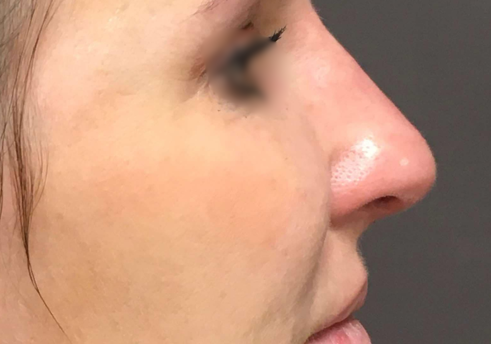 rhinoplastie techniqueSculptR