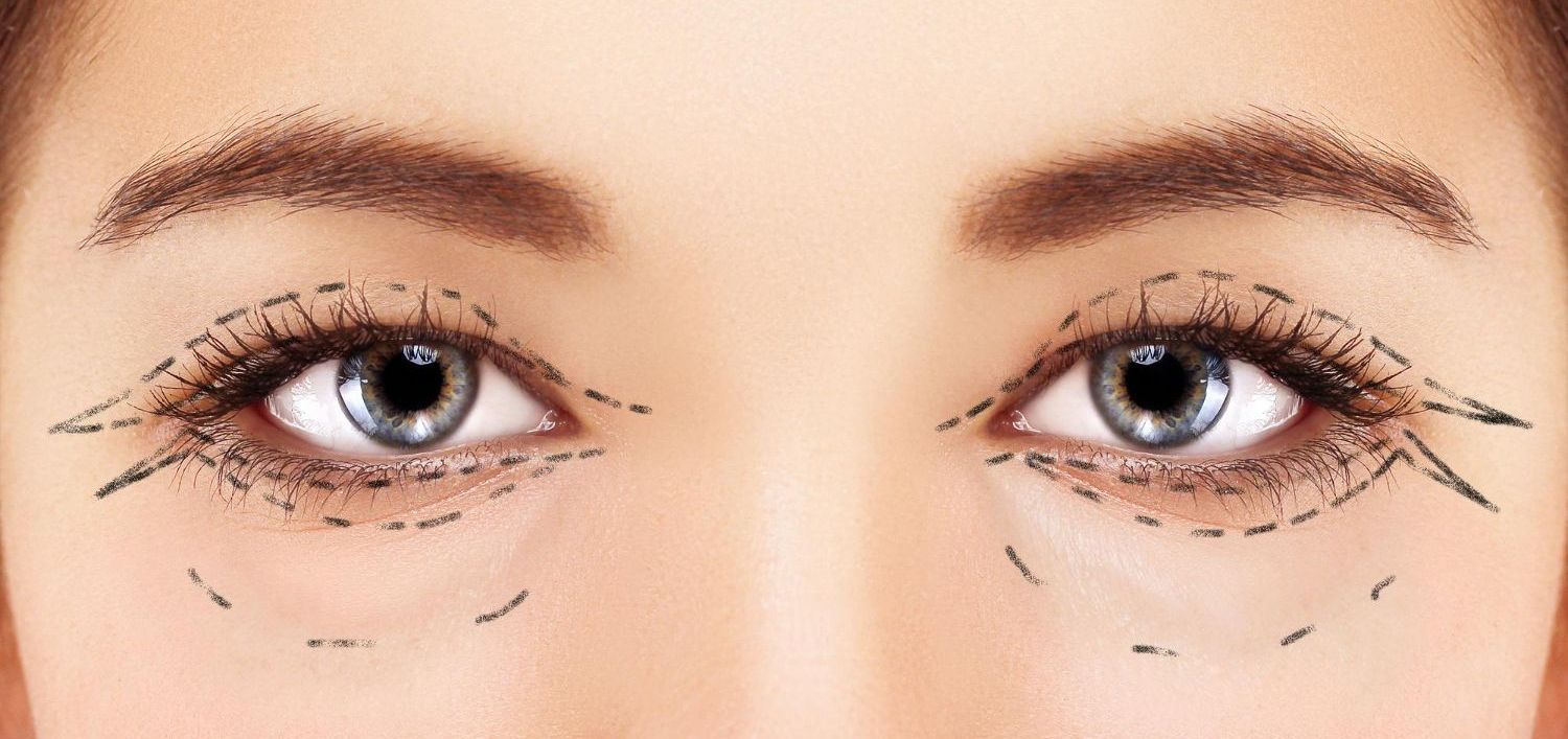 blepharoplastie