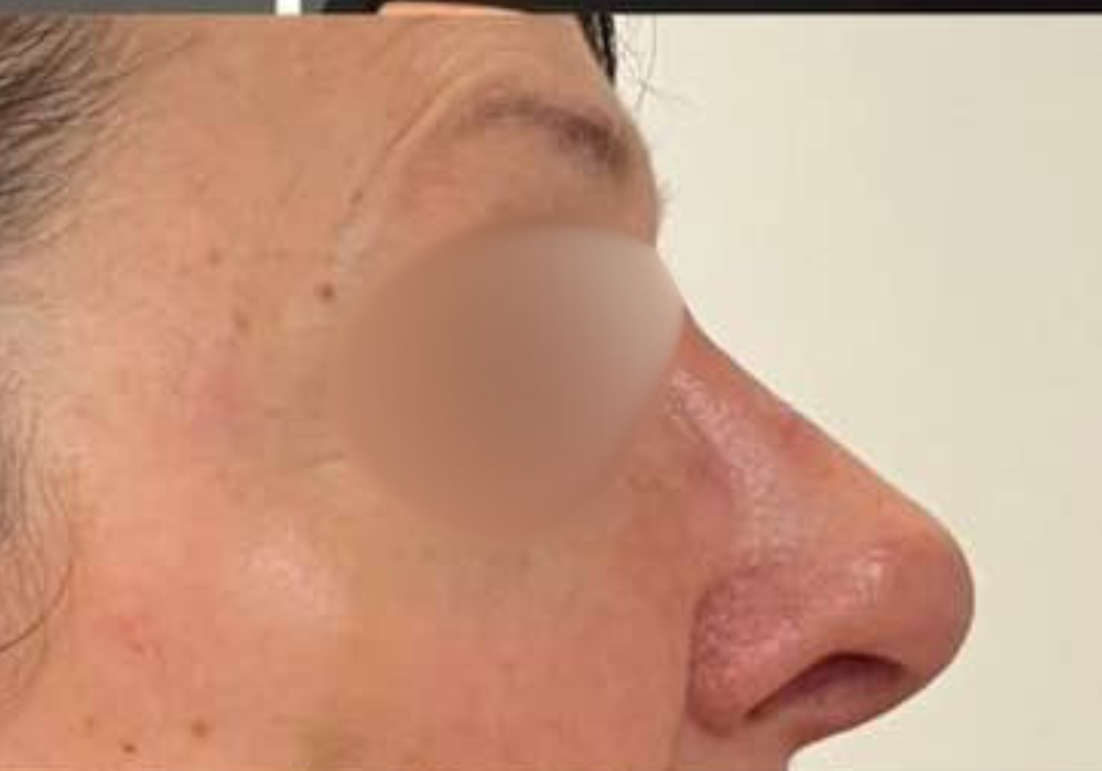 rhinoplastie techniqueSculptR