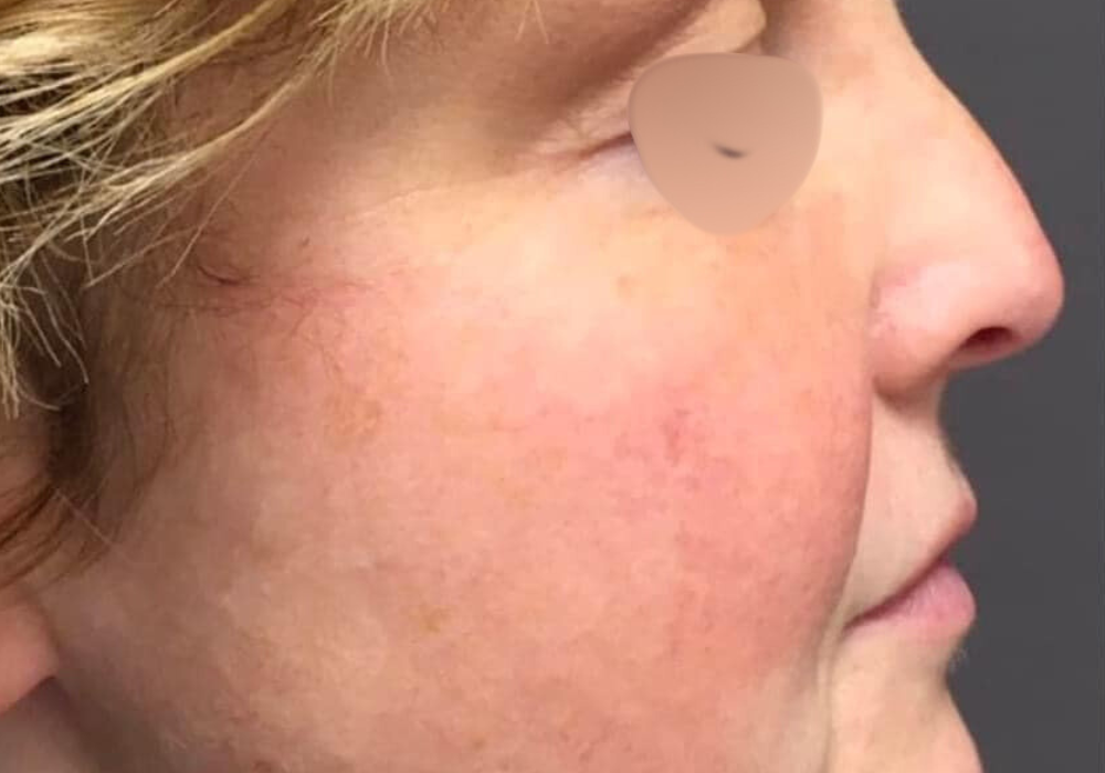 rhinoplastie techniqueSculptR