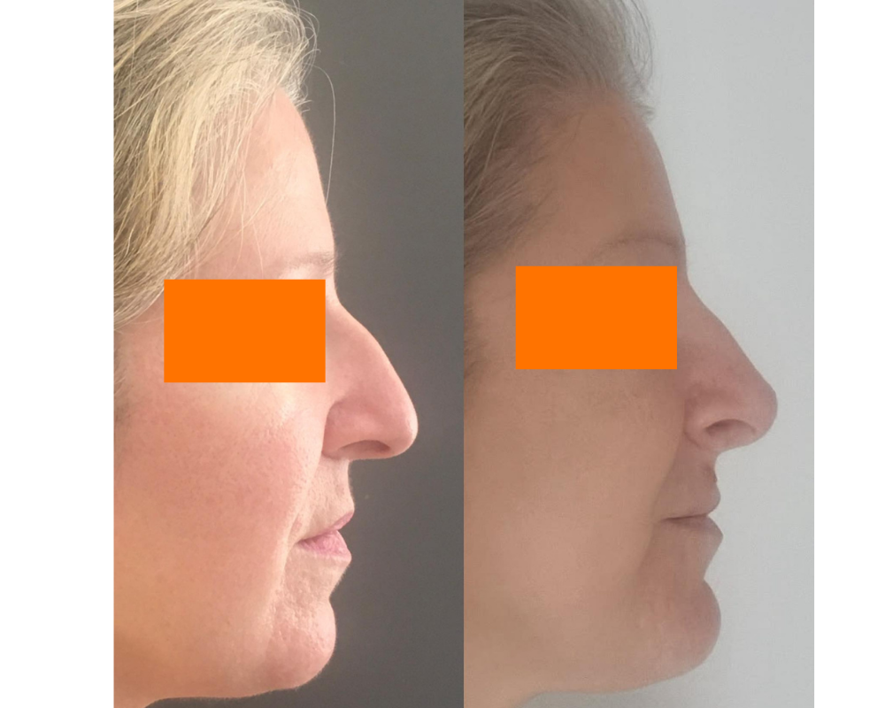 rhinoplastie docteur quezel guerraz