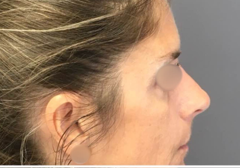 rhinoplastie techniqueSculptR