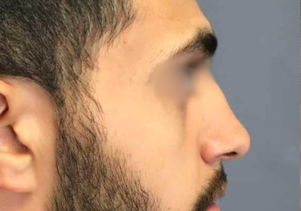rhinoplastie techniqueSculptR