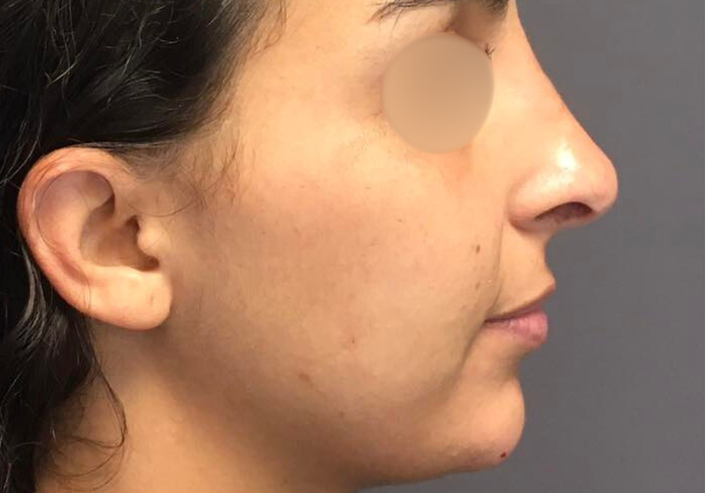 rhinoplastie techniqueSculptR