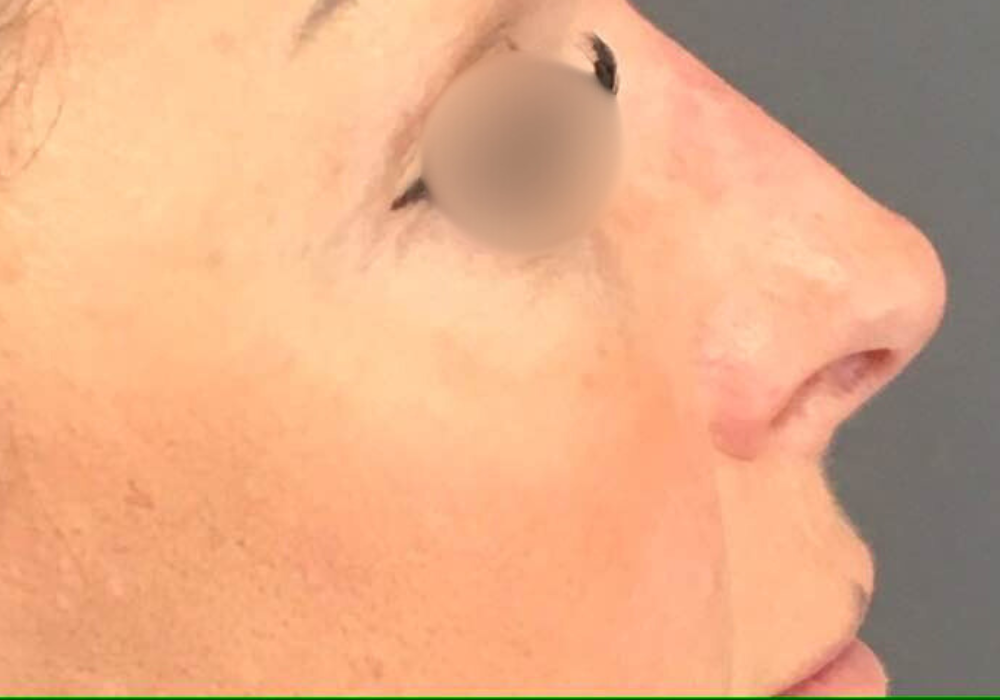 rhinoplastie techniqueSculptR