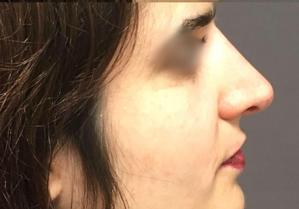 rhinoplastie techniqueSculptR