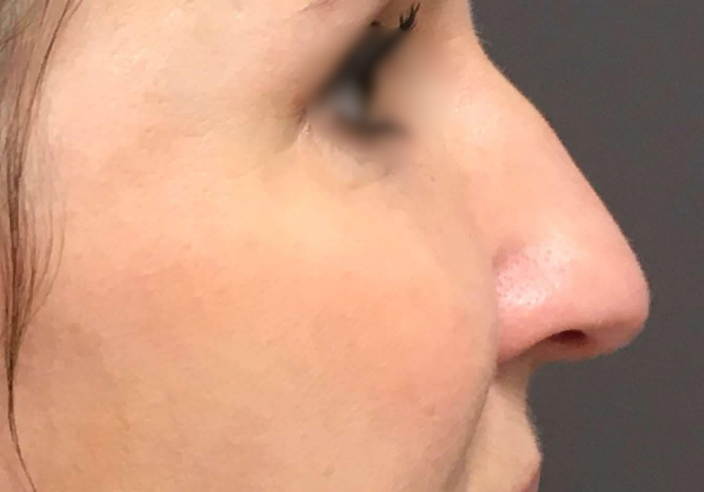 rhinoplastie techniqueSculptR