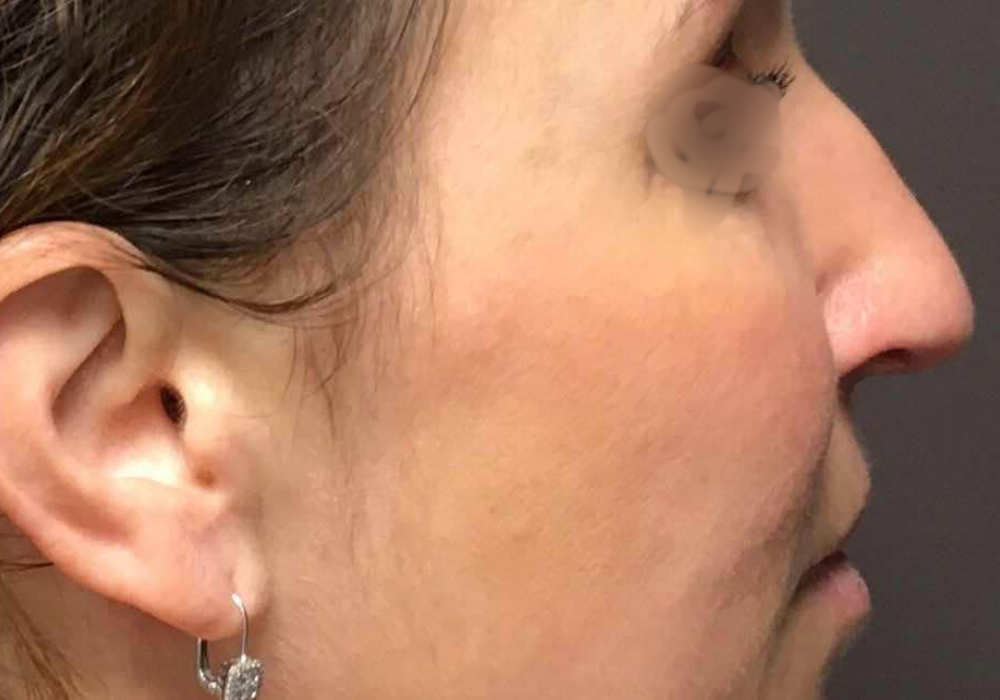 rhinoplastie techniqueSculptR