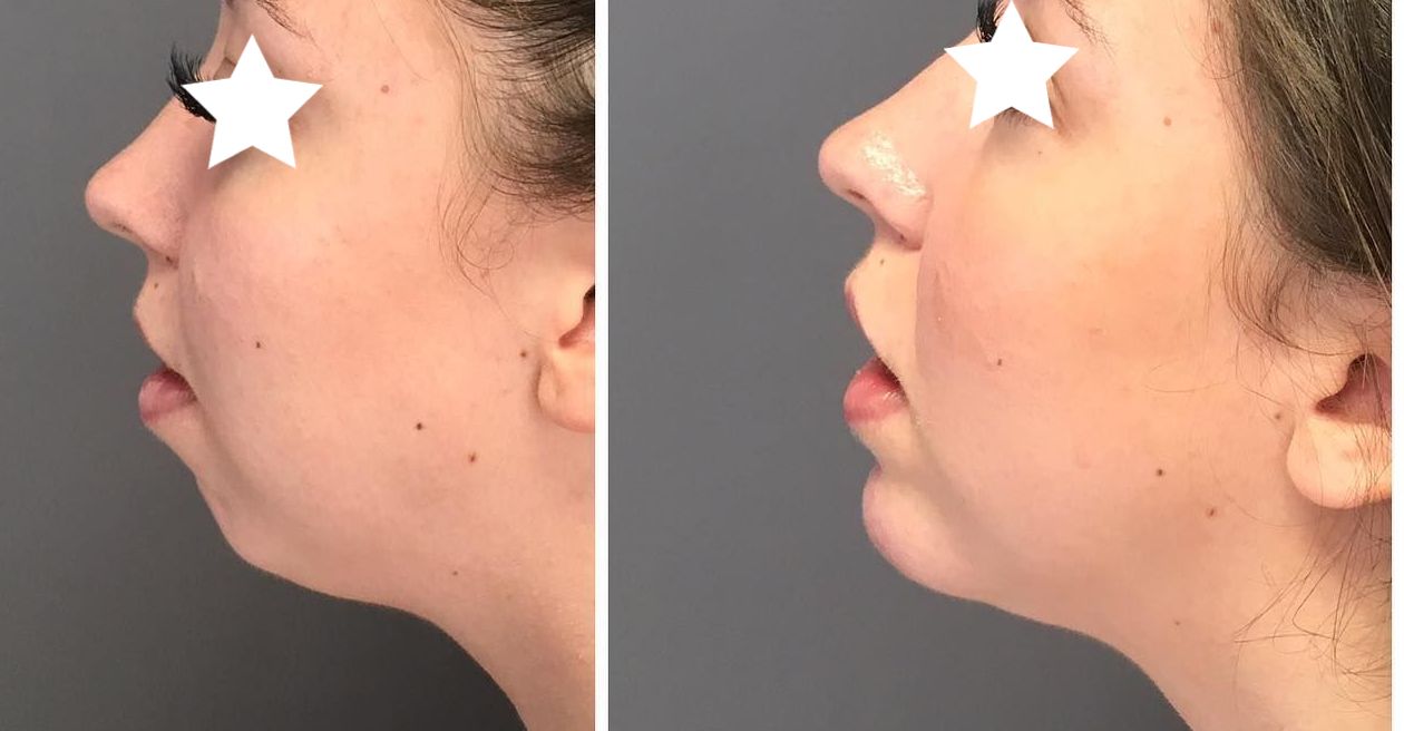 correction de bosse sur le nez a perpignan che zle docteur guerraz