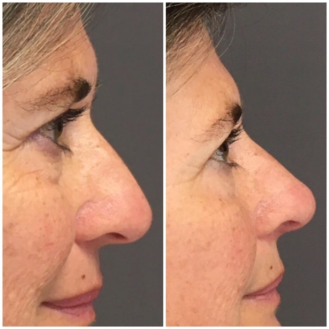 avant apres rhinoplastie docteur quezel guerraz