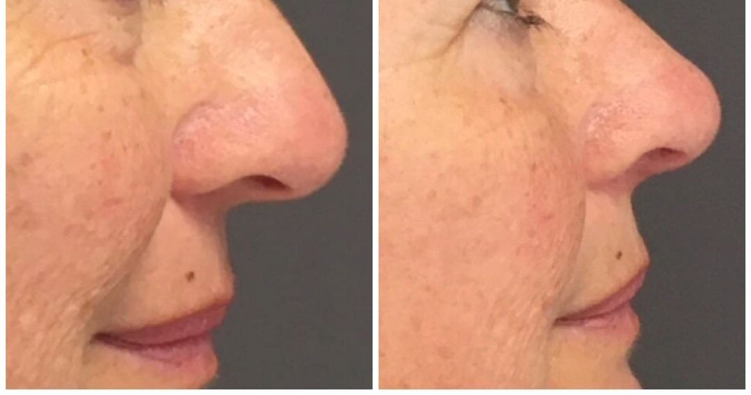rhinoplastie medicale legere relevé de ponte