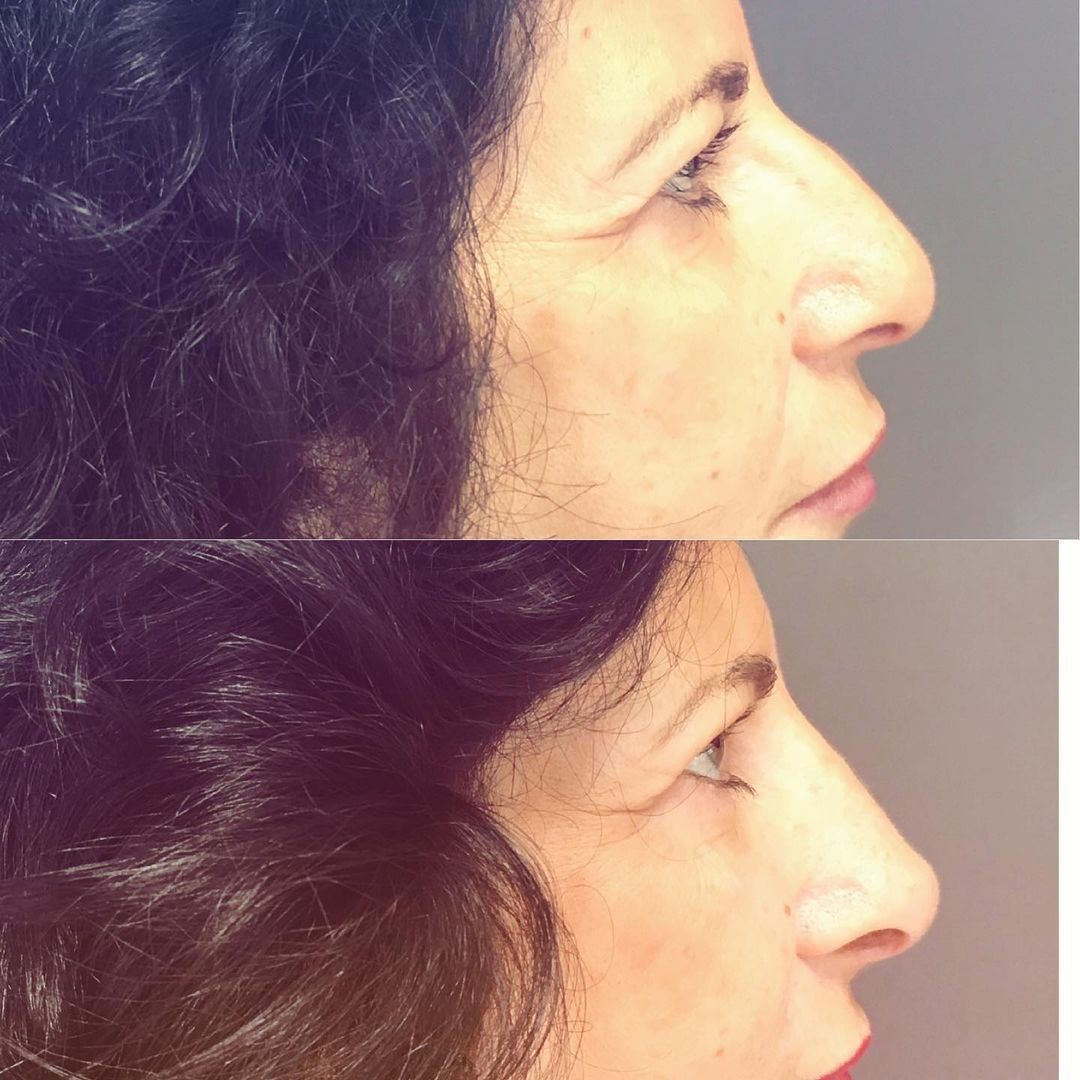 rhinoplastie medicale realsié par le docteur Quezel guerraz