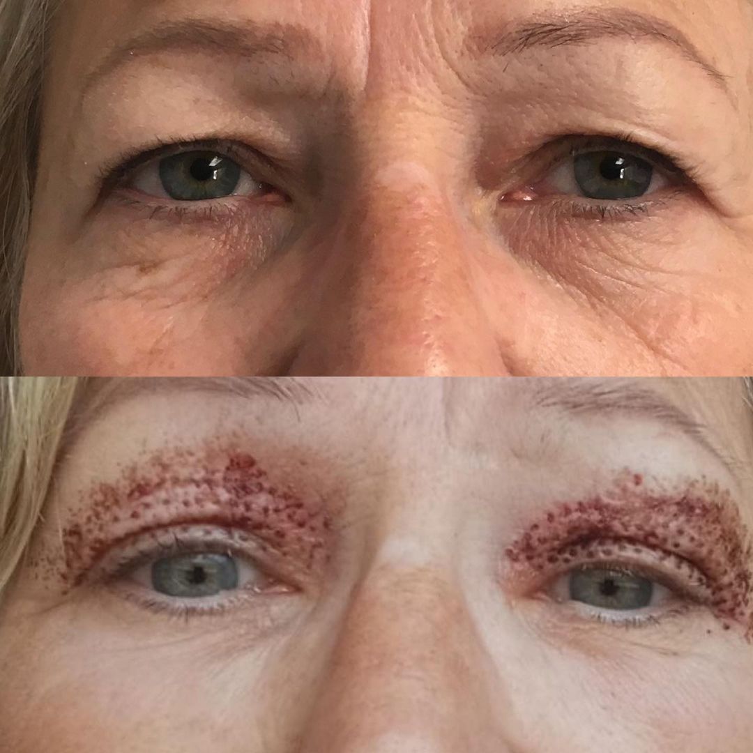 blepharoplastie medicale realisé par le docteur quezel guerraz a perpignan