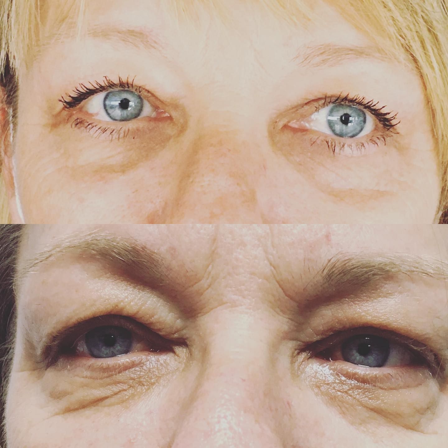 blepharoplastie medicale