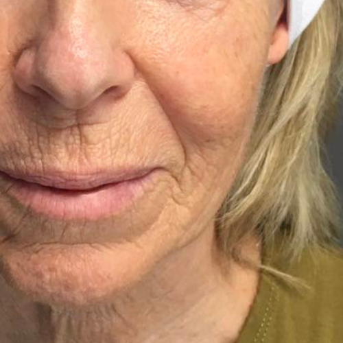 Avant peeling profond aux phenols
