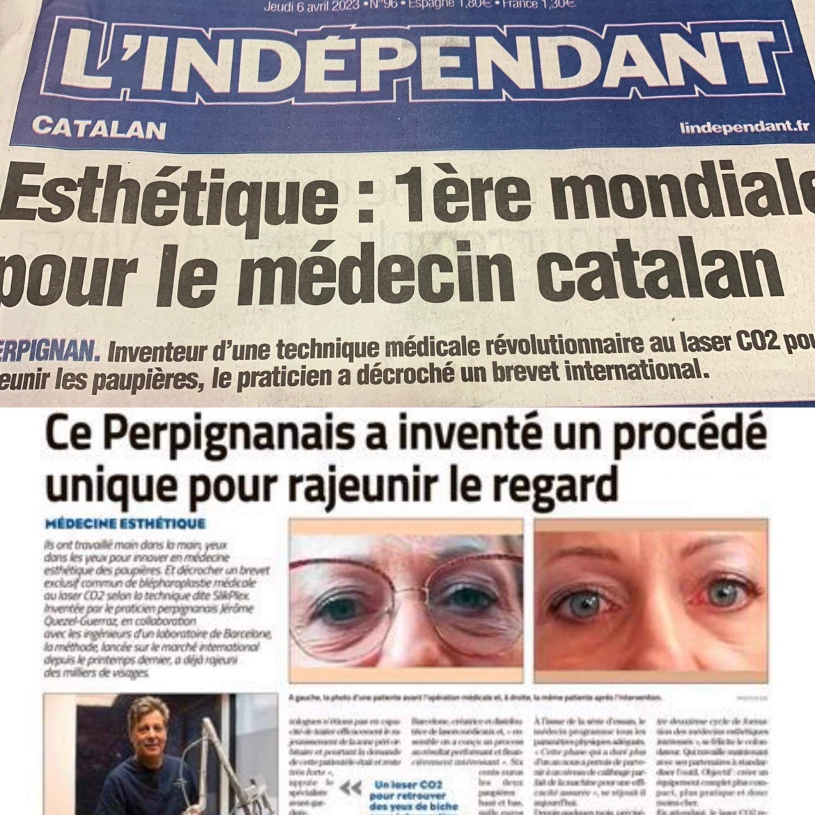 article brevet international de blepharoplastie