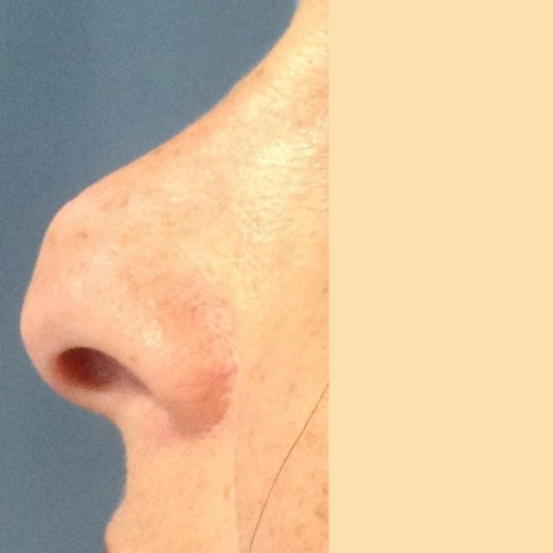rhinoplastie medicale