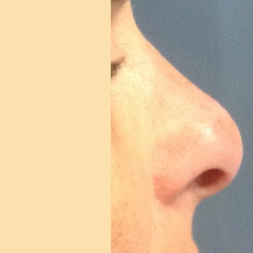 rhinoplastie medicale