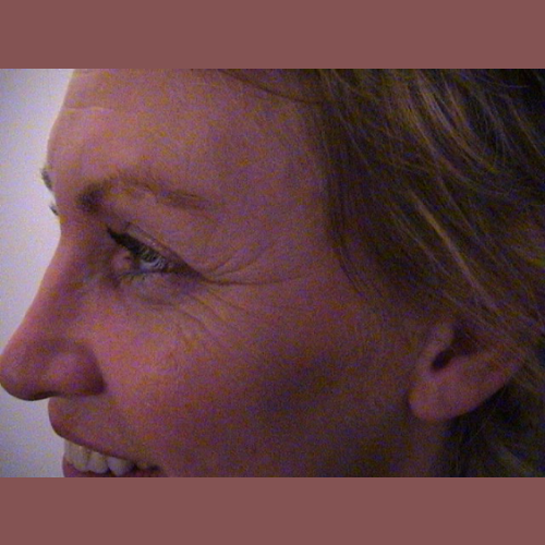 avant botox