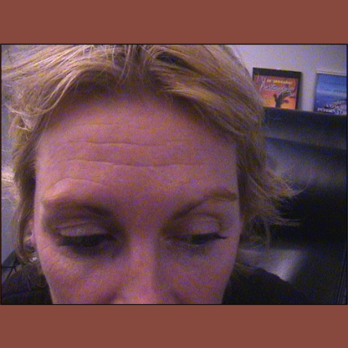 avant botox