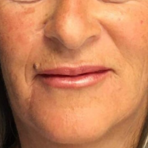 avant / apres endolift