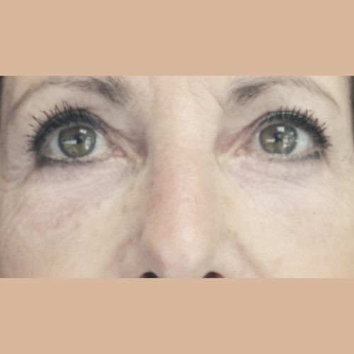 avant / apres endolift