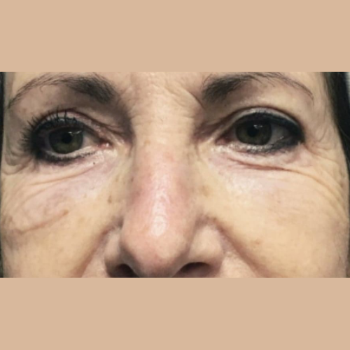 avant / apres endolift