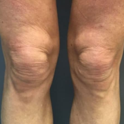 avant / apres endolift