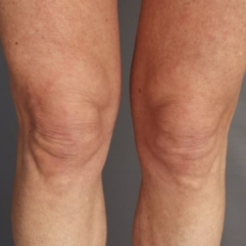 avant / apres endolift