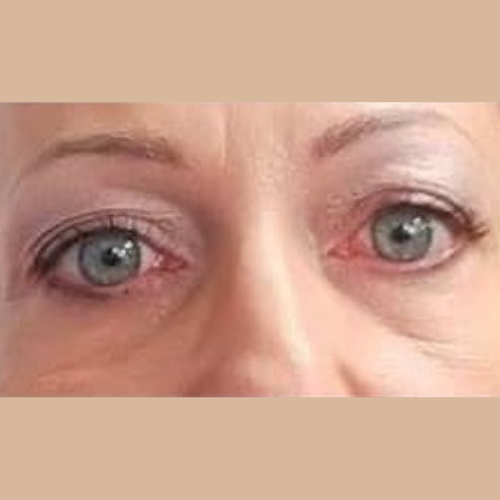 avant / apres technique blepharoplastie du docteur Quezel Guerraz