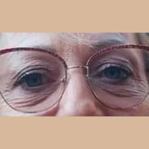 avant / apres technique blepharoplastie du docteur Quezel Guerraz