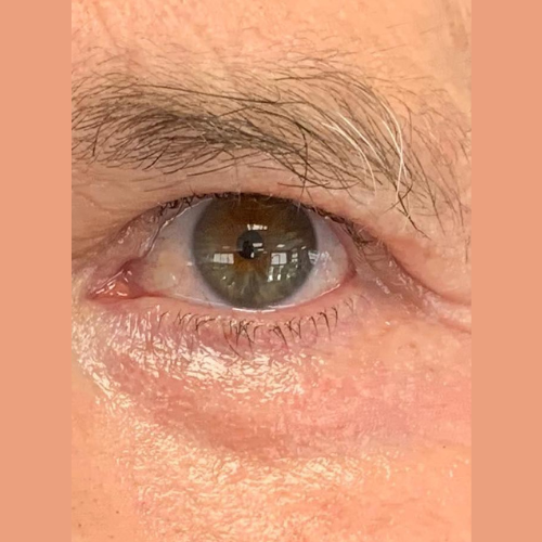 avant/apres sur les rides et paupieres des yeux