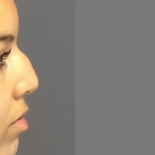 avant / apres rhinoplastie Quezel guerraz