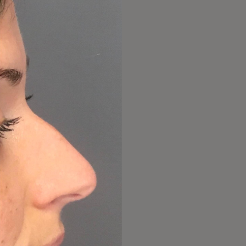 avant / apres rhinoplastie Quezel guerraz