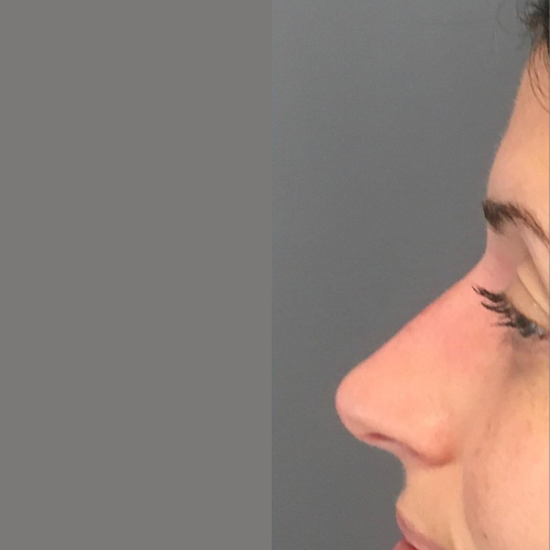 avant / apres rhinoplastie Quezel guerraz