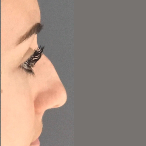 avant apres la rhinoplastie medicale