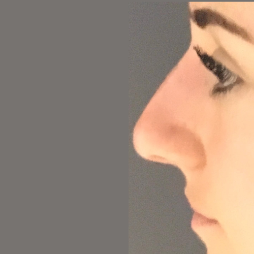 avant apres la rhinoplastie medicale