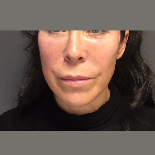 avant / apres fils tenseurs