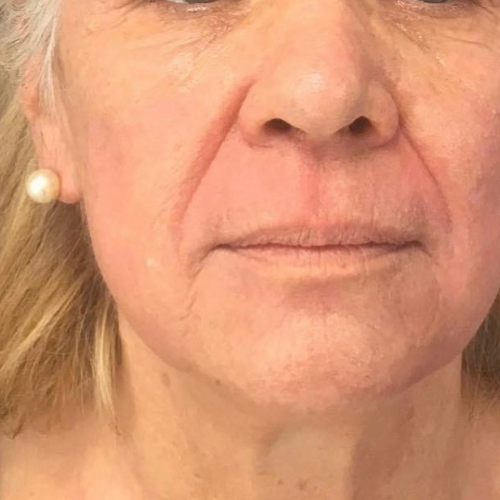 avant / apres peeling profond phenol