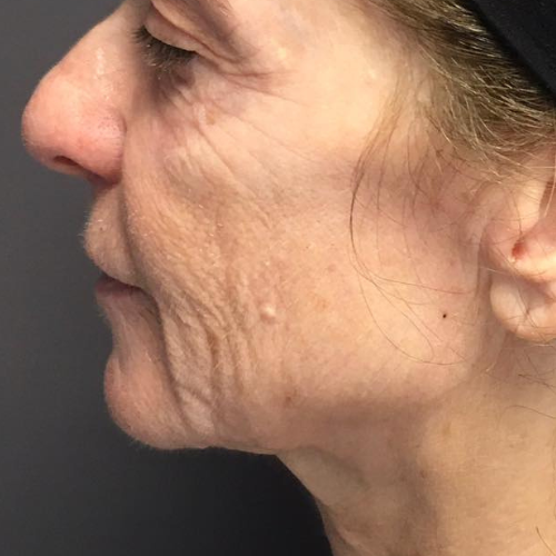avant / apres peeling profond phenol