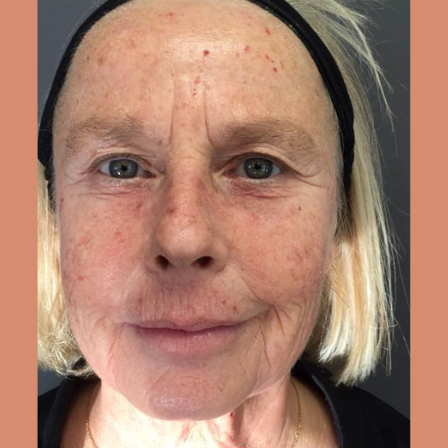 avant / apres peeling profond phenol