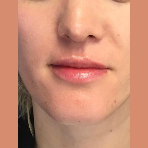augmentation des levres