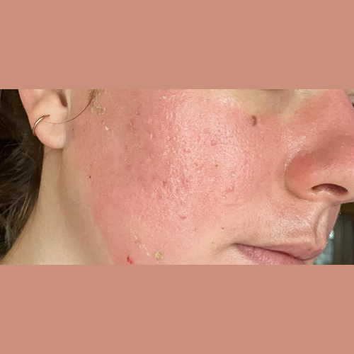 apres peeling