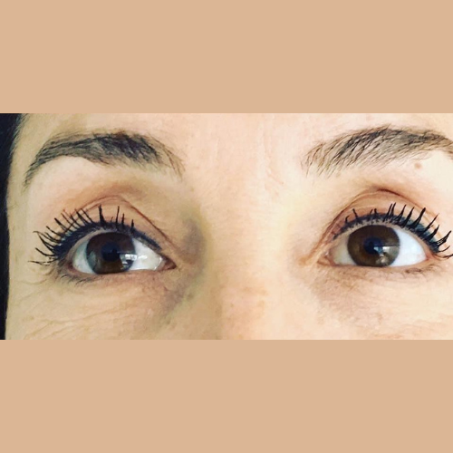 avant apres correction d'un oeil creux